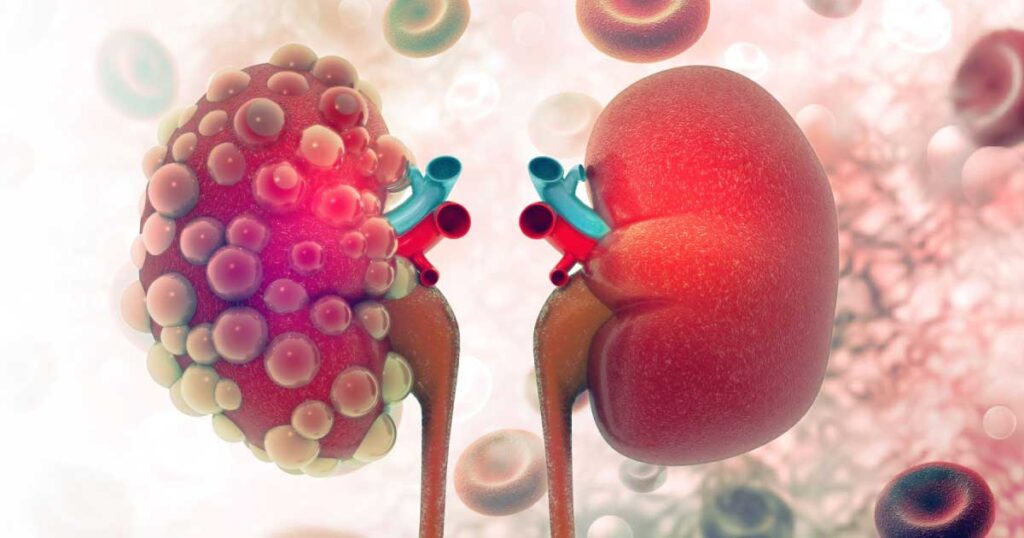 What is Kidney Disease?